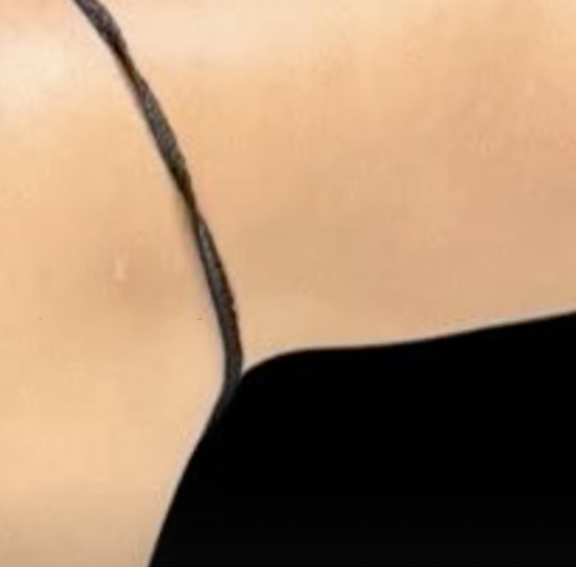 LIPO SCAR
